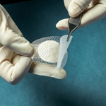 Kerecis Combines Fish-Skin Graft and Silicone Cover for Wound Treatment